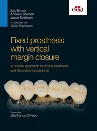 Fixed prosthesis with vertical margin closure - Librerie.coop