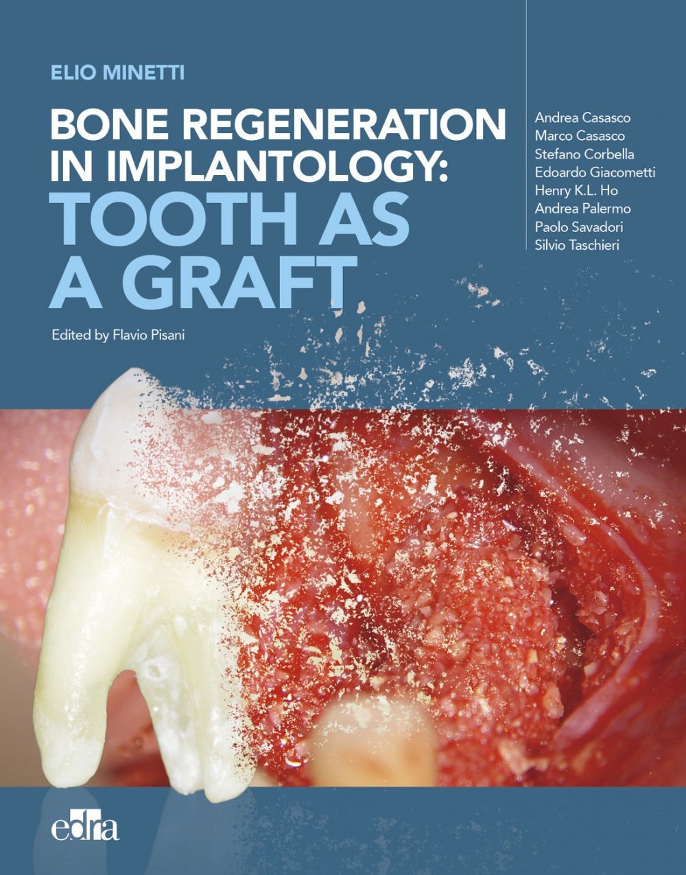 Bone regeneration in implantology: tooth as a graft - Librerie.coop